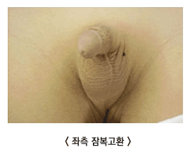 잠복고환