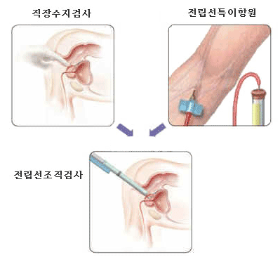 전립선암 검사 이미지