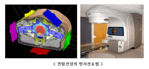 전립선암 검사 이미지