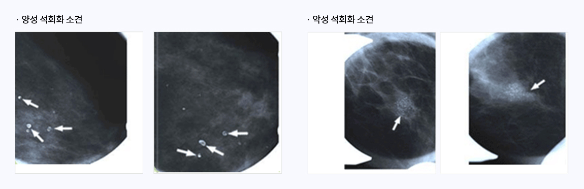 유방촬영 이미지
