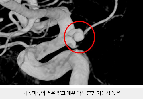 뇌동맥류