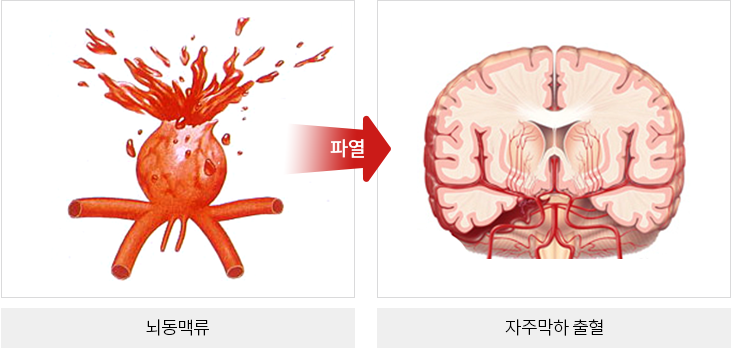 뇌동맥류와 지주막하출혈