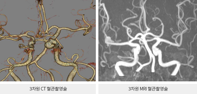 뇌동맥류 진단
