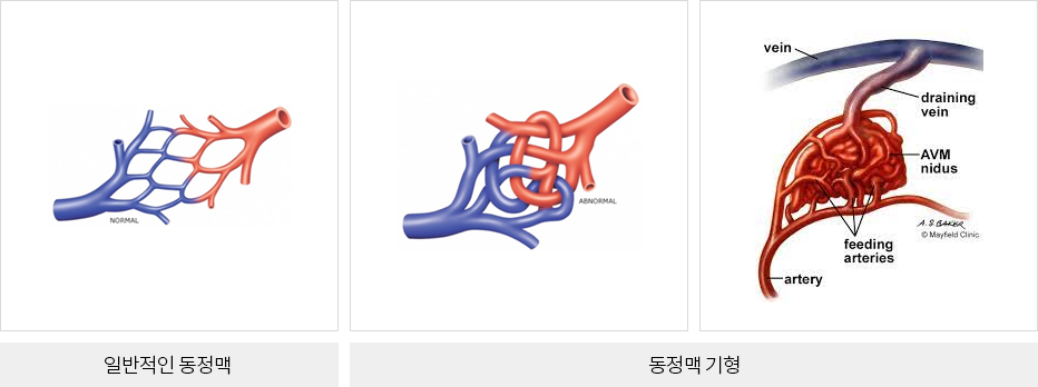 동정맥 기형